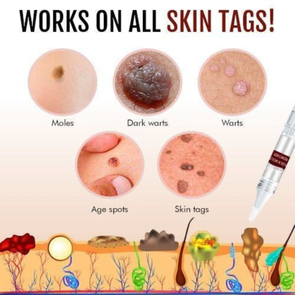 Enleveur de Tags et de Grains de Beauté